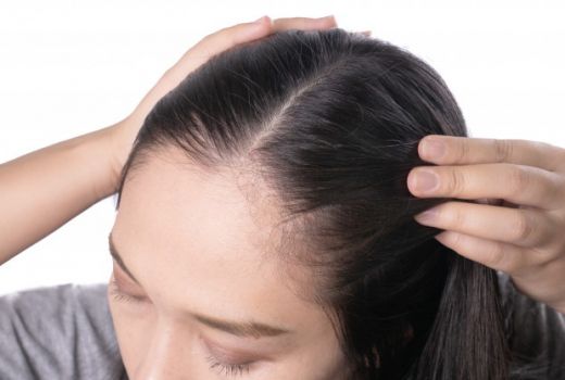 5 Mitos Tentang Ketombe yang Harus Kamu Tahu - GenPI.co