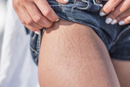 Jangan Salah! Stretch Mark juga Bisa Dialami Para Remaja Lo - GenPI.co
