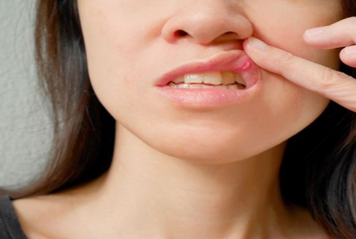 Bukan Kekurangan Vitamin C, Ternyata Ini Penyebab Sariawan - GenPI.co