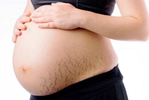 Stretch Mark Mengganggu? Begini Cara Sederhana Mengatasinya - GenPI.co