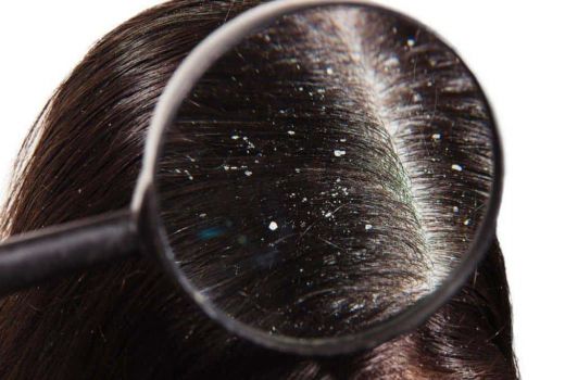 Mau Rambut Bebas Ketombe? Harus Keramas Setiap Hari - GenPI.co
