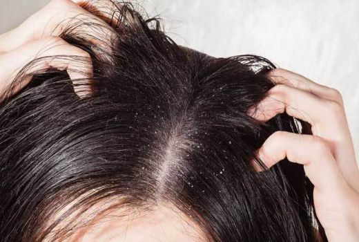 Putus Asa untuk Atasi Ketombe? 4 Masker Bahan Alami Ini Solusinya - GenPI.co