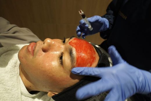Treatment PRP, Tuntaskan Bekas Jerawat dengan Serum Plasma Darah - GenPI.co