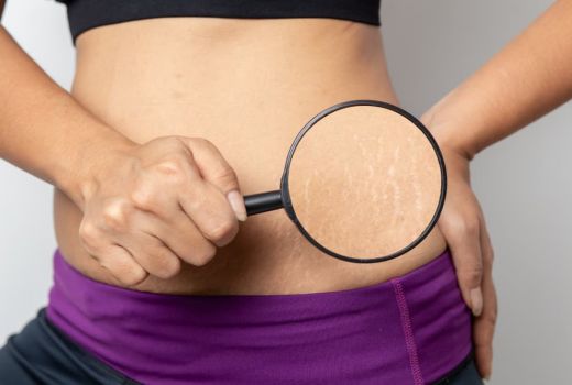 Lidah Buaya Ternyata Ampuh Banget untuk Menyamarkan Stretch Mark - GenPI.co