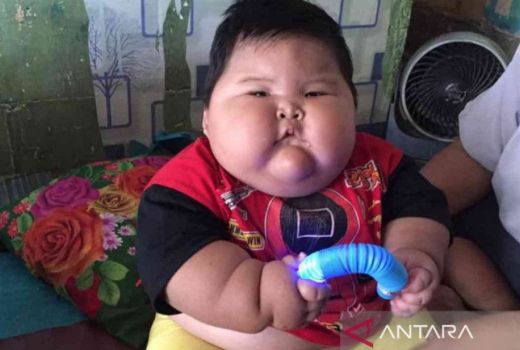 Balita Obesitas di Bekasi Jalani Terapi Penurunan Berat Badan - GenPI.co JABAR