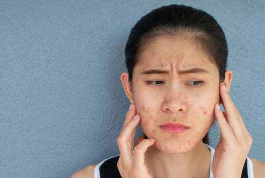 5 Tips Menghilangkan Bekas Jerawat, Rajinlah Cuci Muka - GenPI.co JATENG