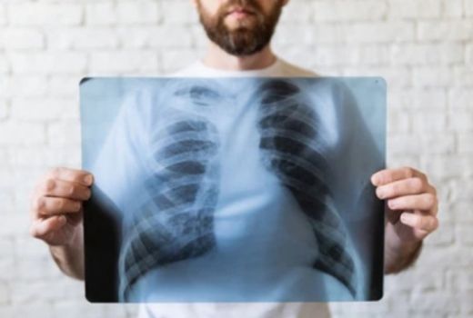 5 Tips Berikut Bisa Buat Kamu Terhindar dari Tuberkolosis - GenPI.co JATIM