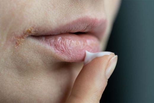 Merawat Bibir Kering Saat Puasa, Mudah, Perhatikan - GenPI.co JATIM