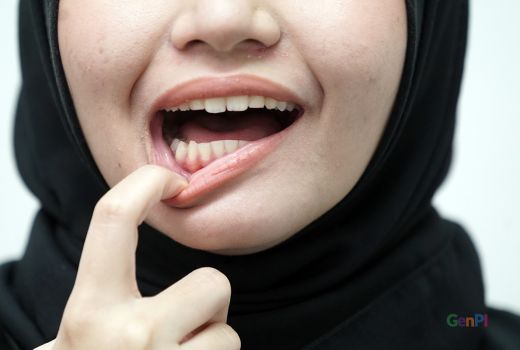 Kanker Mulut Mengintai, Ini 6 Cara Ampuh Mencegahnya - GenPI.co JOGJA