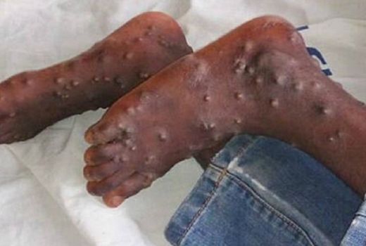 Awas Cacar Monyet, Berawal di Singapura Bisa Mampir ke Indonesia - GenPI.co