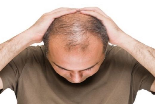 Hindari Rambut Botak, Pakai 5 Bahan Alami Ini - GenPI.co