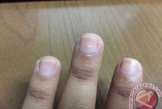 Tangan Terjepit Pintu? ini Cara Sederhana Obati - GenPI.co NTB