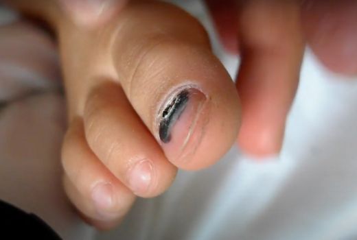 Benarkah Kemunculan Garis Hitam di Kuku Pertanda Kanker Melanoma? - GenPI.co SULTRA