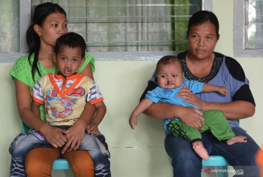 Ada Kabar Gembira untuk Anak-anak Berbibir Sumbing di OKU Timur - GenPI.co SUMSEL
