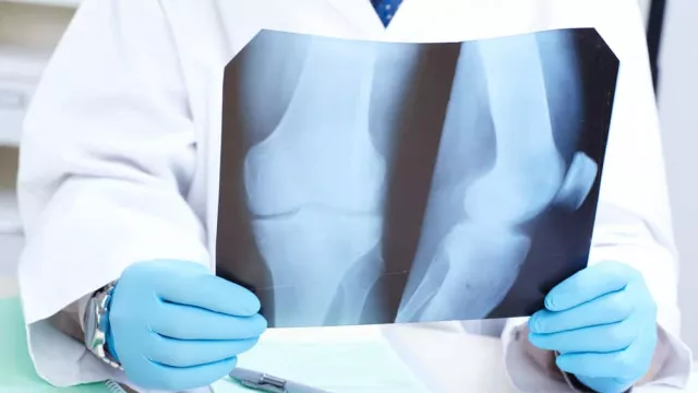 Ternyata Hal Ini Menyebabkan Osteoporosis, Bisa Patah Tulang Lo - GenPI.co