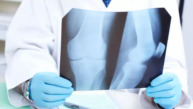 3 Makanan Ini Sebaiknya Dihindari untuk Mencegah Osteoporosis - GenPI.co