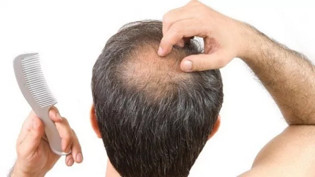 Pria Botak Tak Usah Minder, Ini 4 Cara Rambut Tumbuh Lebat Instan - GenPI.co