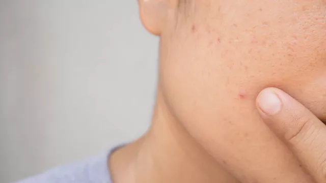 Wajah Sedang Beruntusan? Jangan Skip 4 Urutan Skincare Ini - GenPI.co