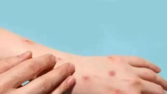 Santri di Meranti Riau Meninggal Diduga Cacar Monyet, 2 Orang Suspek - GenPI.co Santri di Meranti Riau Meninggal Diduga Cacar Monyet, 2 Orang Suspek - GenPI.co