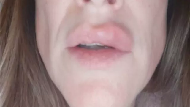 Mengerikan, Bibir Wanita Ini Meledak Setelah Lakukan Filler - GenPI.co