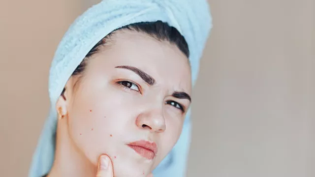 Beruntusan Bikin Nggak Pede, Atasi dengan 3 Produk Skincare Ini! - GenPI.co Beruntusan Bikin Nggak Pede, Atasi dengan 3 Produk Skincare Ini! - GenPI.co