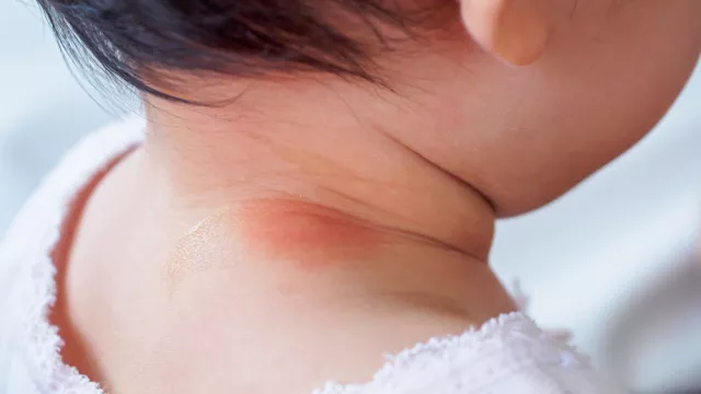 Mom, 3 Hal Ini Jadi Penyebab Leher Bayi Merah - GenPI.co Mom, 3 Hal Ini Jadi Penyebab Leher Bayi Merah - GenPI.co