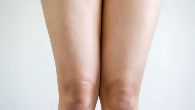 Cerahkan Lutut Hitam dengan 4 Bahan Alami - GenPI.co