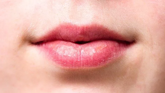 3 Cara Alami Menghilangkan Bibir Kering dan Pecah-Pecah - GenPI.co JATIM
