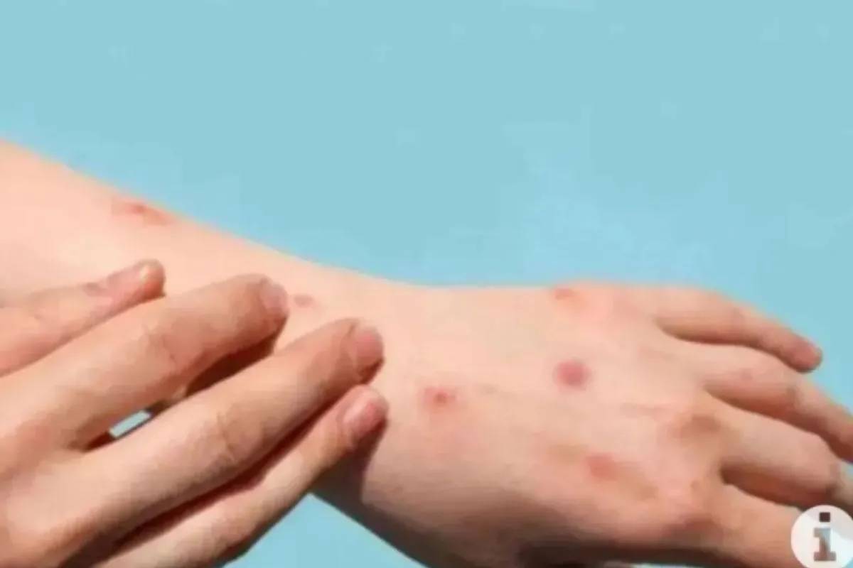 Santri di Meranti Riau Meninggal Diduga Cacar Monyet, 2 Orang Suspek